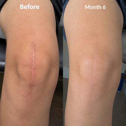 Soovia™ Scar Repair Silicone Stick